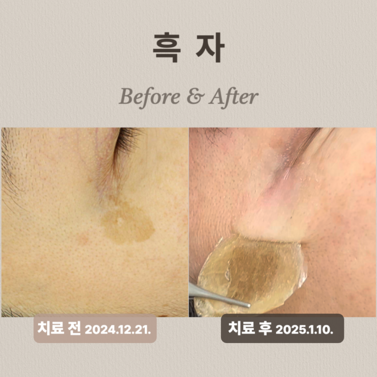 50대 여성 흑자 치료 후기