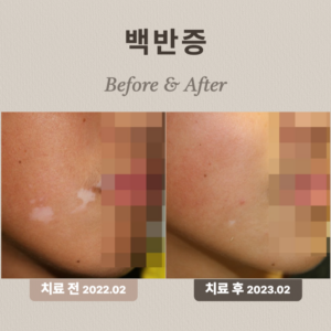 10대 백반증