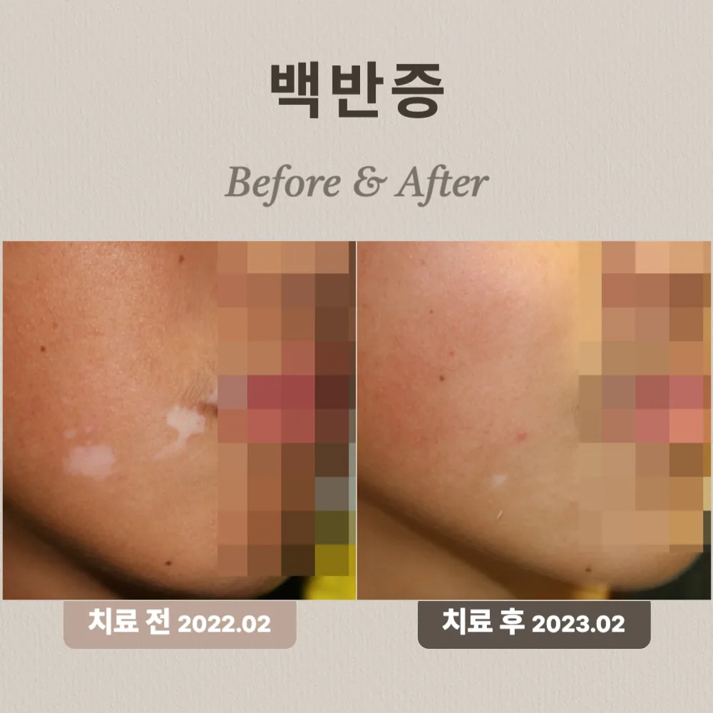 13세 아이, 백반증 치료 사례
