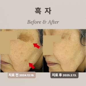 60대여성흑자