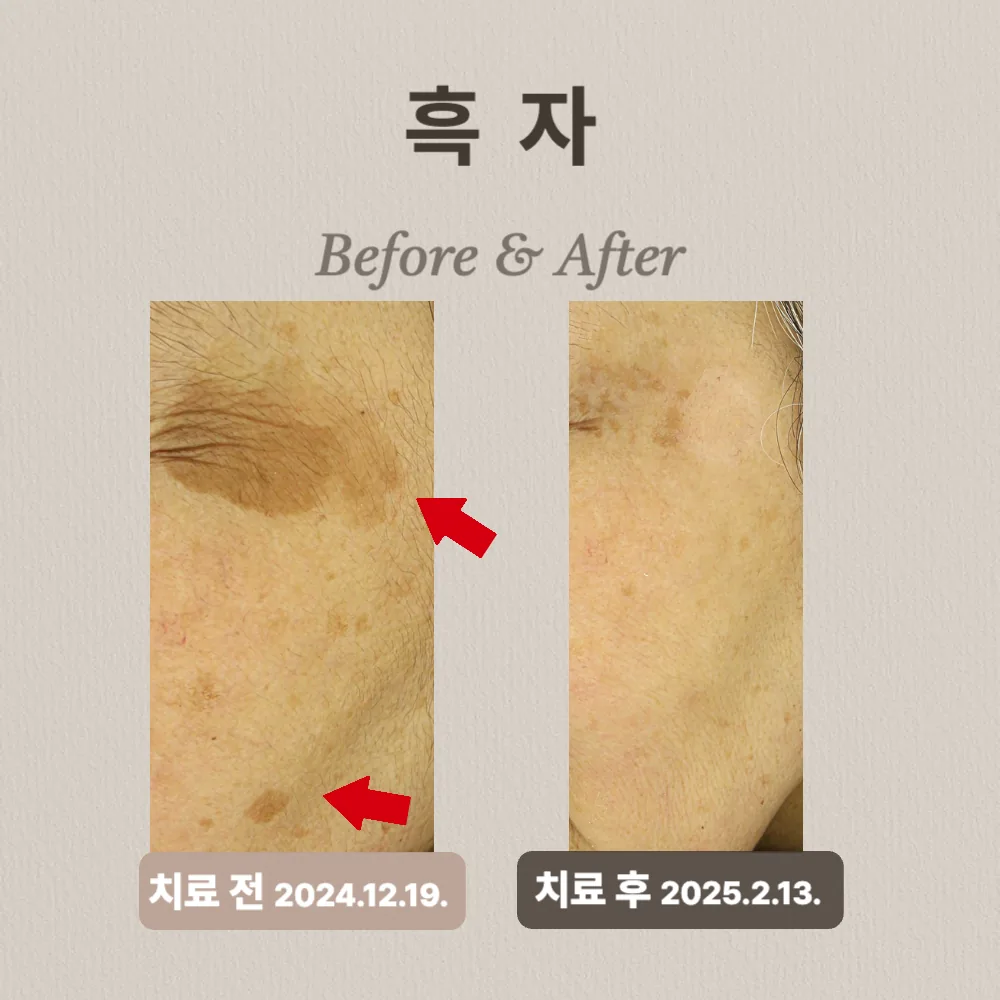 60대 여성 흑자 치료 후기
