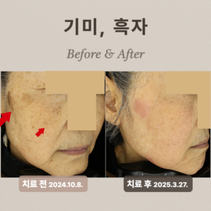 60대 여성 기미 흑자