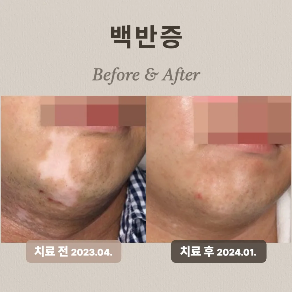 40대 남성 백반증 치료 사례