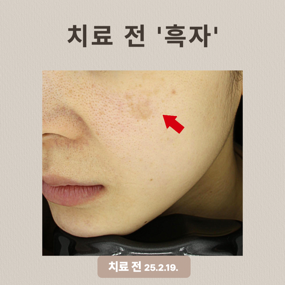 피부과 흑자 사례 리팟레이저