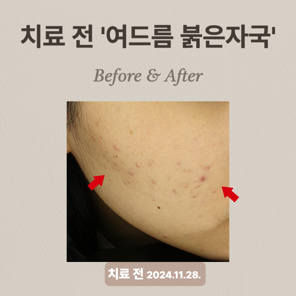 20대 여성 여드름 홍반
