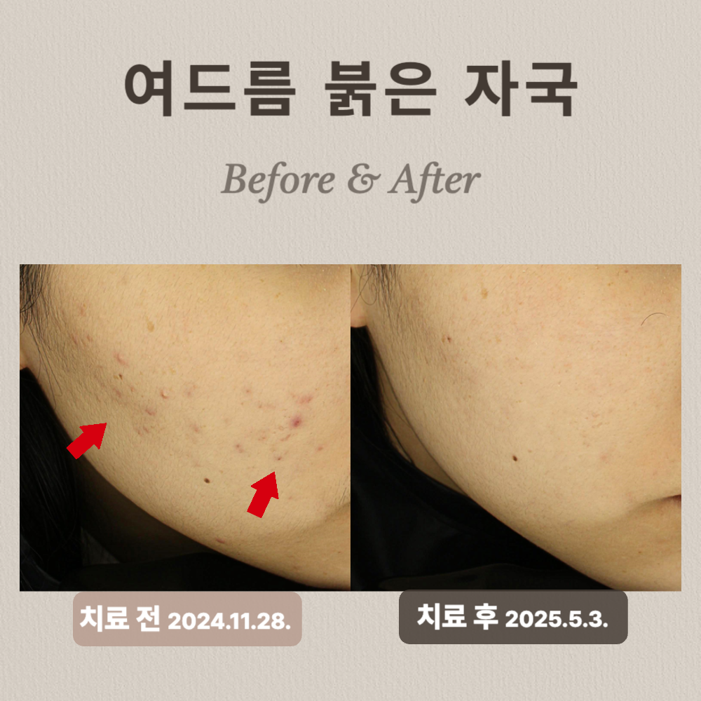 여드름 붉은자국