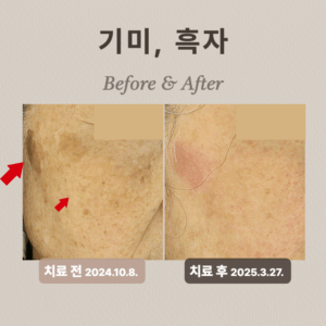 기미, 흑자