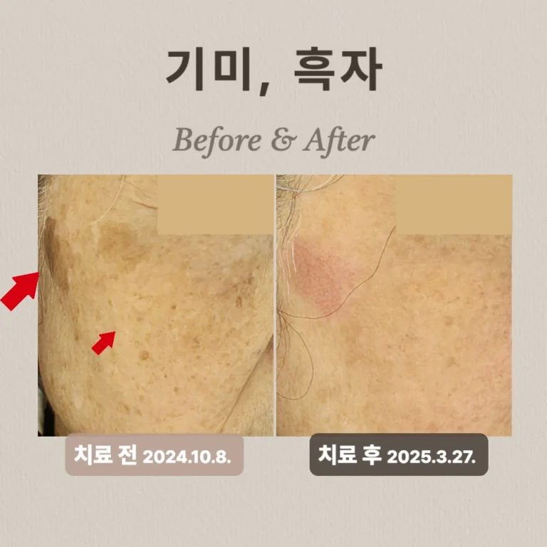 60대 여성, 기미, 흑자 치료 후기