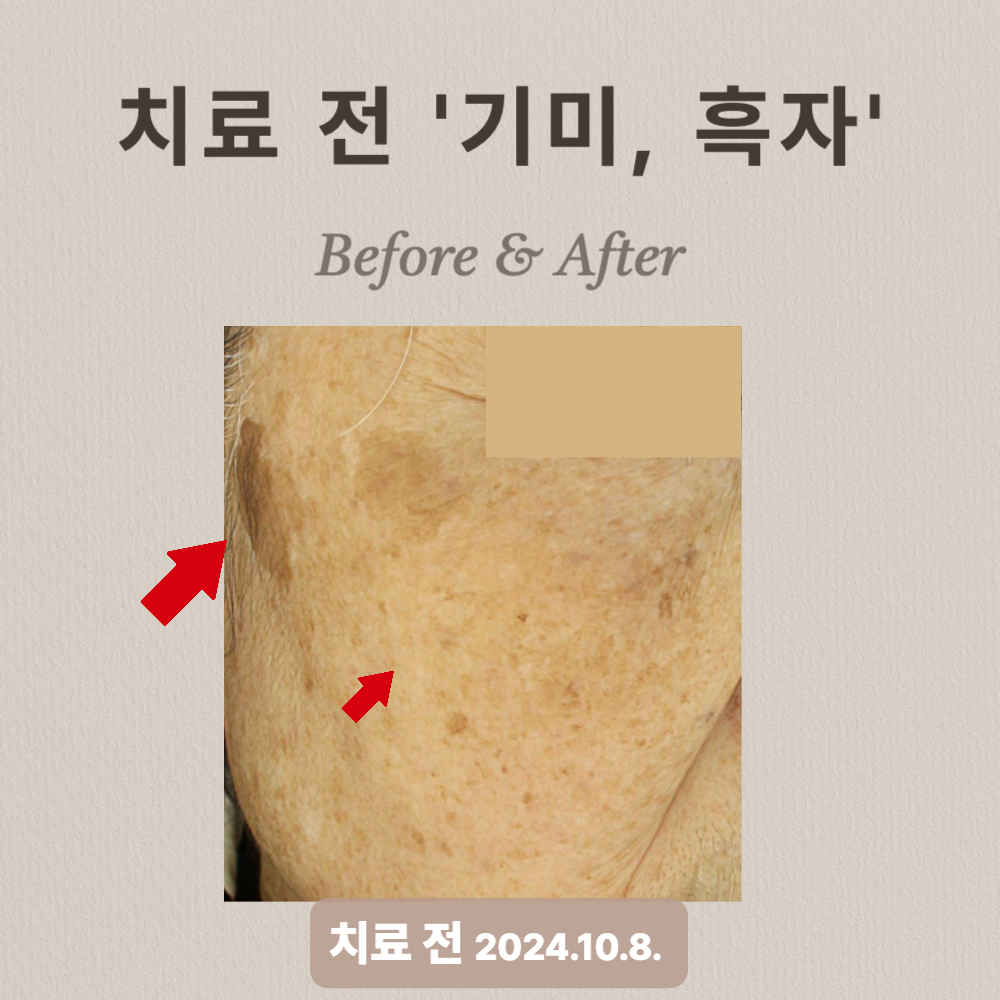 기미, 흑자