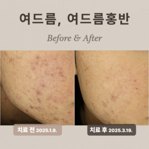 여드름홍반