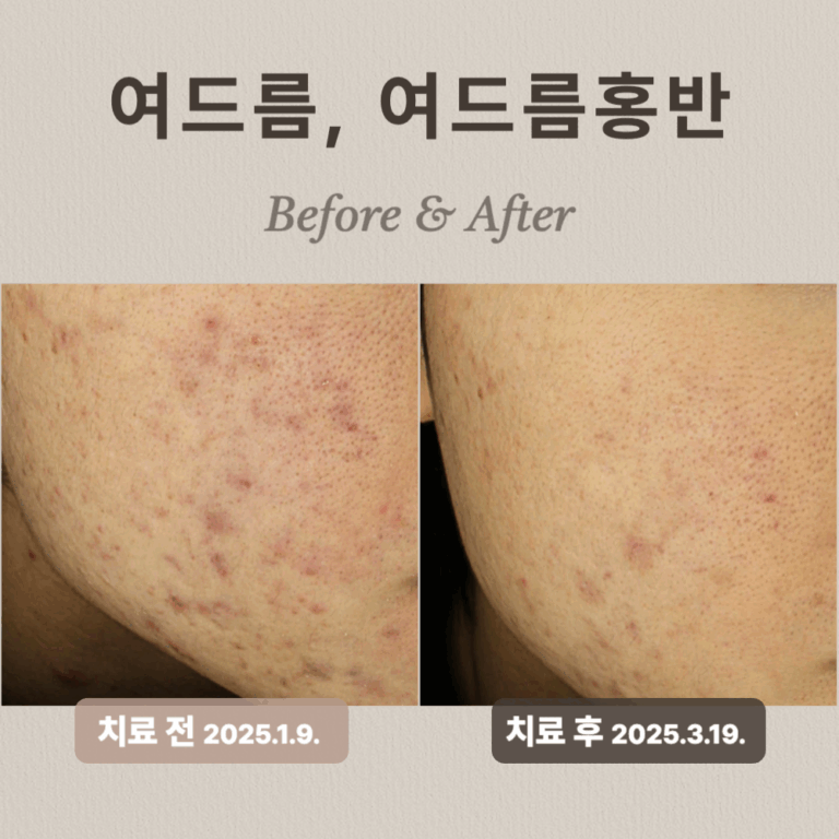 20대 남성, 여드름, 여드름홍반 치료 후기