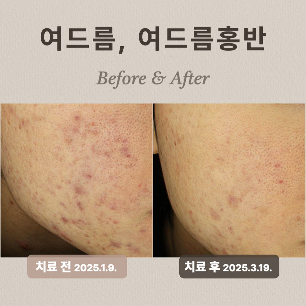 여드름홍반