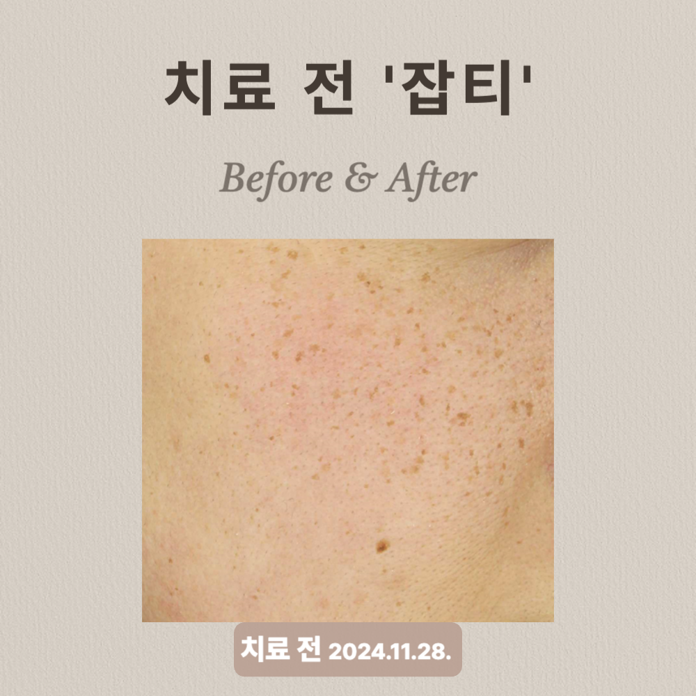 잡티 치료