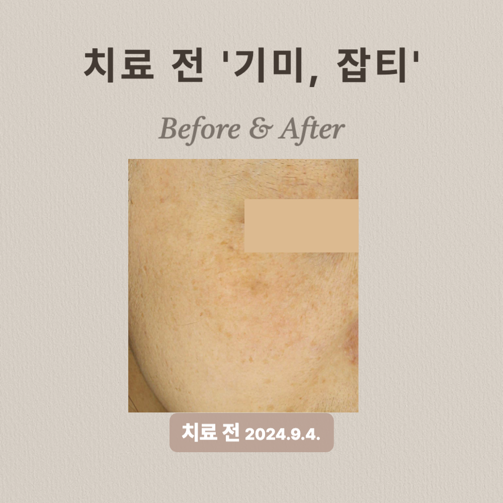 기미, 잡티