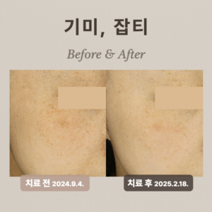 기미, 잡티