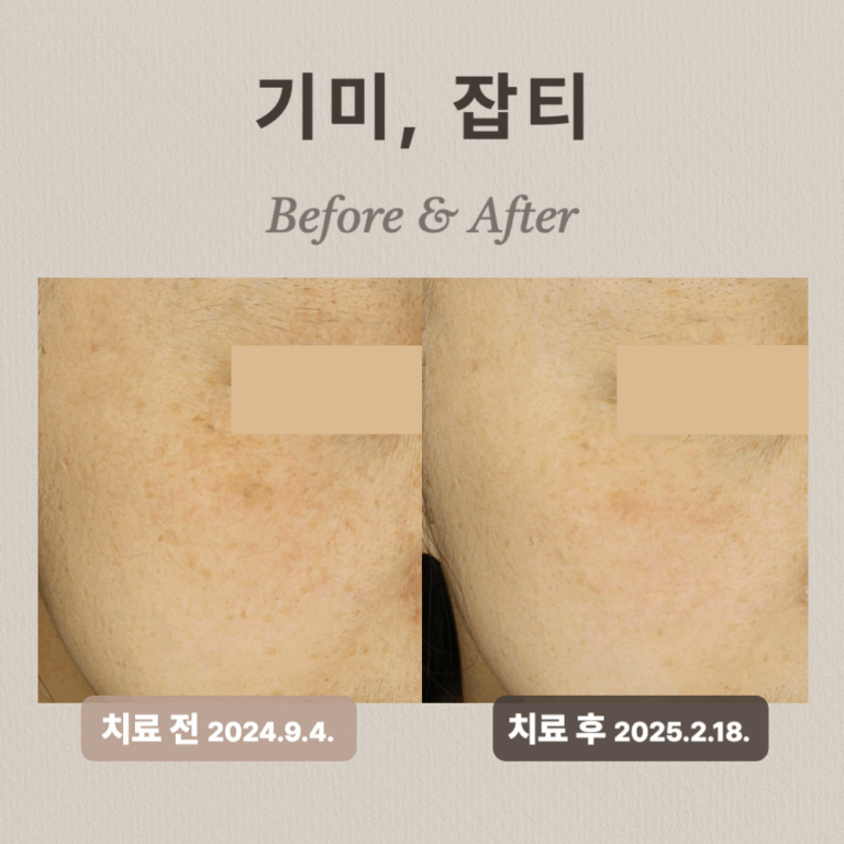 30대 여성, 기미, 잡티, 홍조 치료 후기