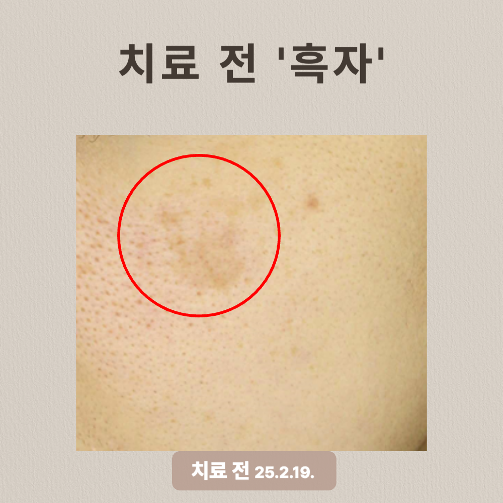 흑자 리팟레이저