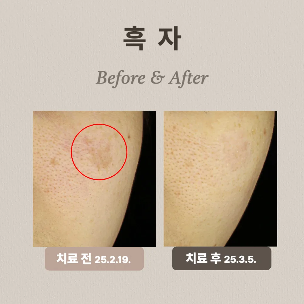 30대 흑자 치료 후기