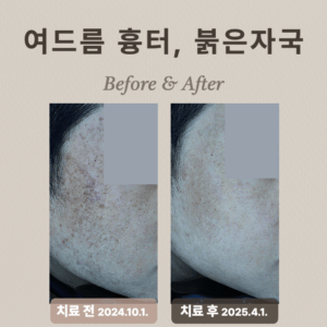 여드름 흉터, 홍반