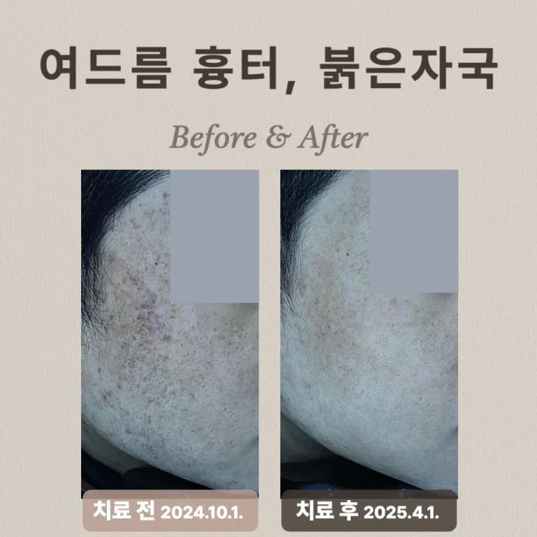20대 남성, 여드름흉터 및 복합적 피부질환 치료 후기