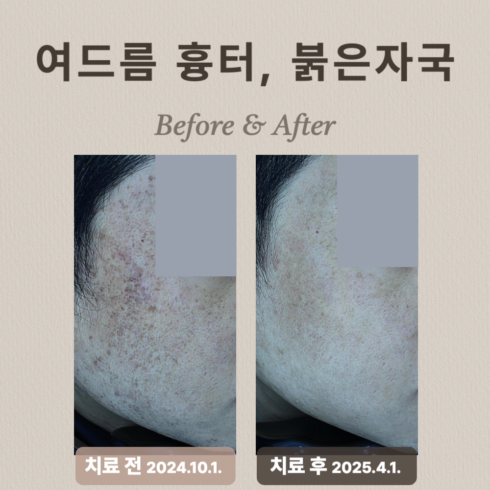 여드름 흉터, 홍반