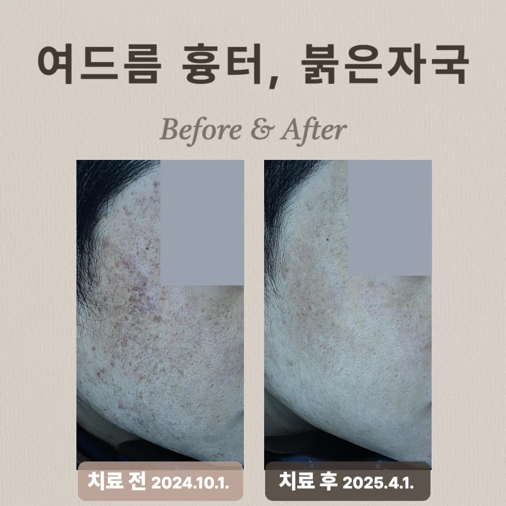 20대 남성, 여드름흉터 및 복합적 피부질환 치료 후기