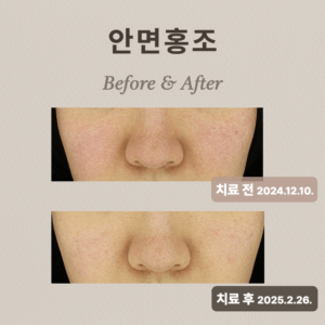 안면홍조 브이빔