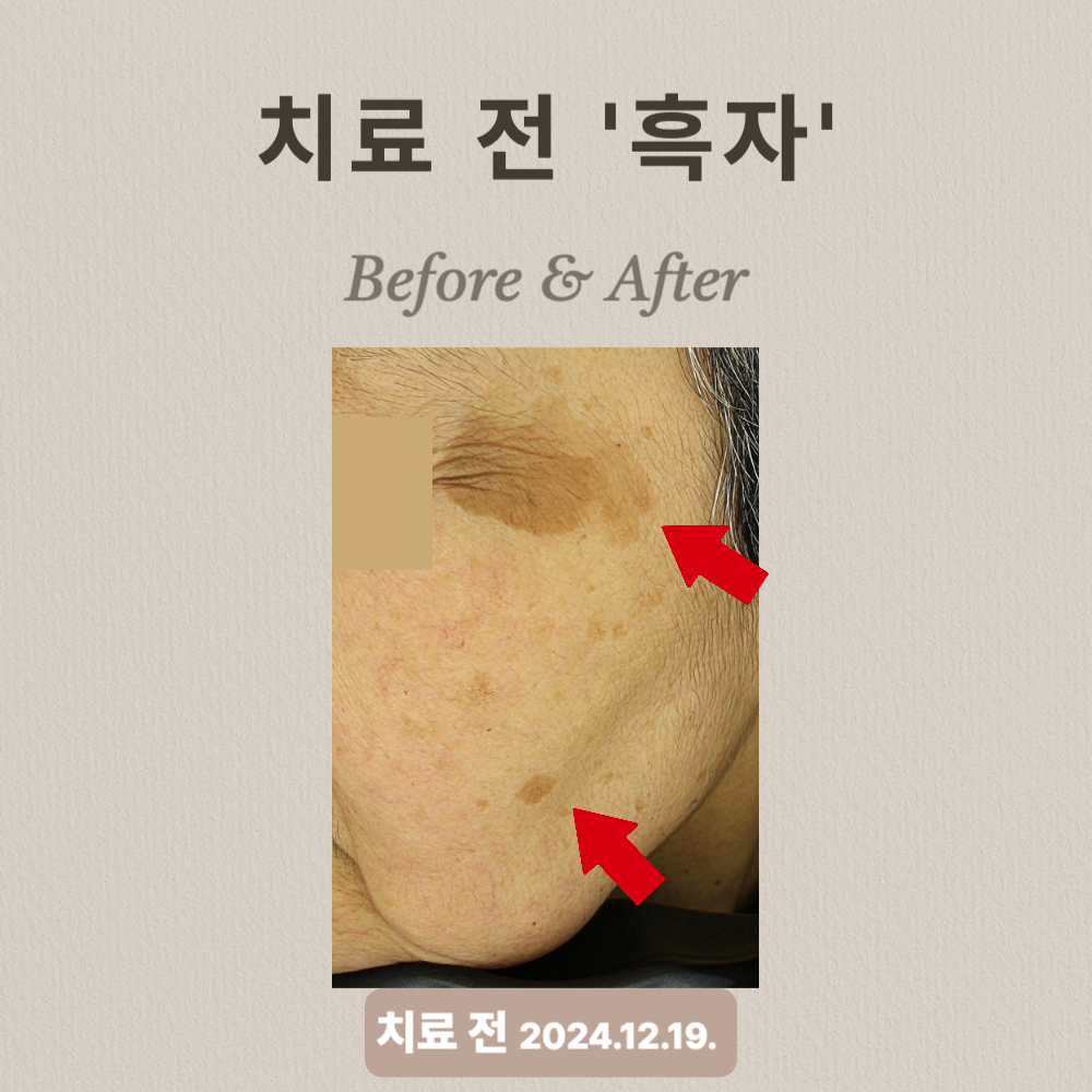 60대 흑자 제거