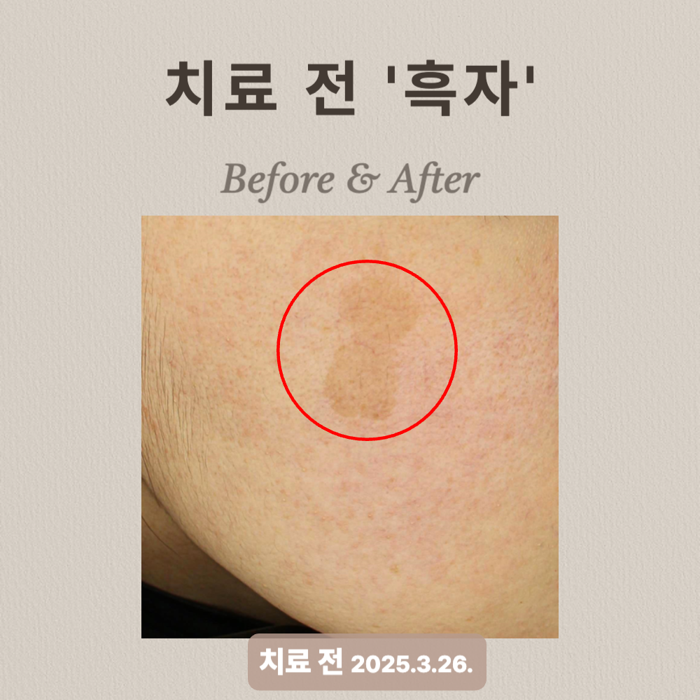 20대 흑자 제거