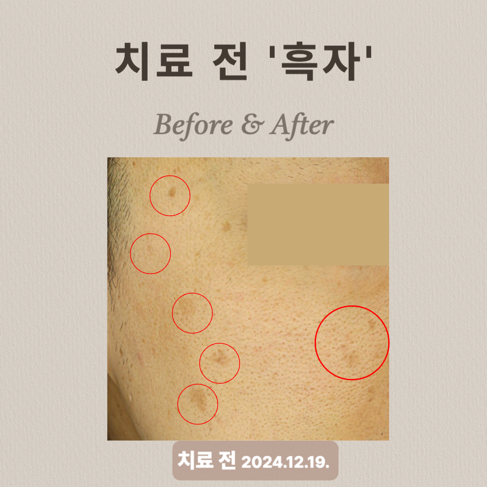 40대 흑자 제거 리팟레이저
