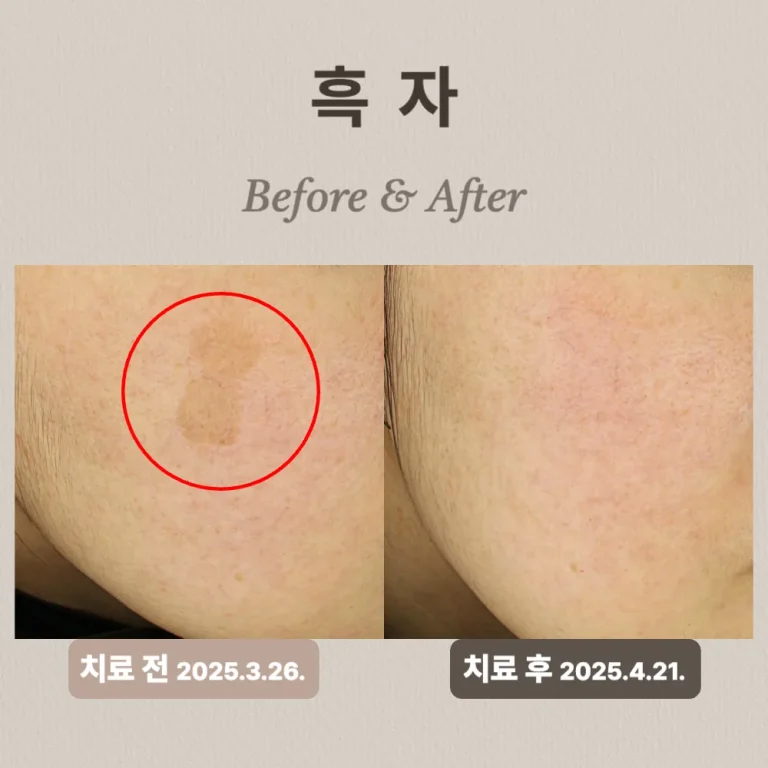 20대 흑자 치료 후기