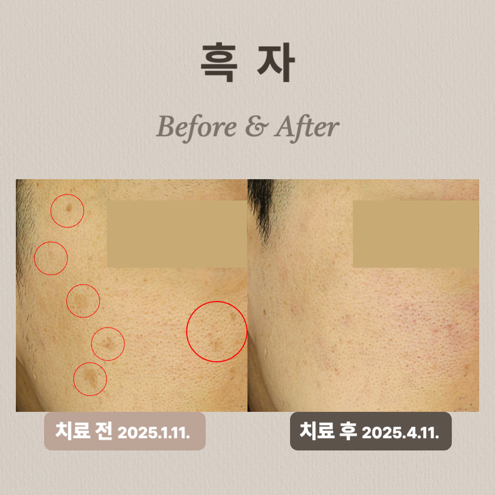 40대 흑자 제거 리팟레이저