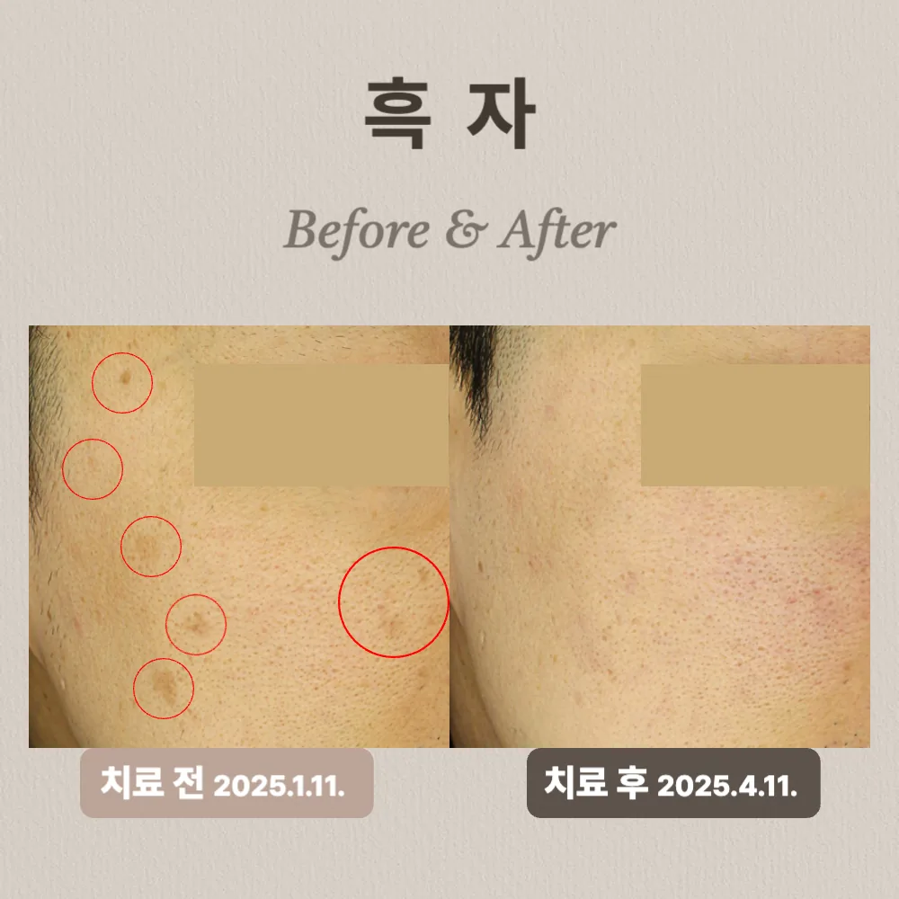 40대 남성 눈가와 양볼 흑자 치료 사례