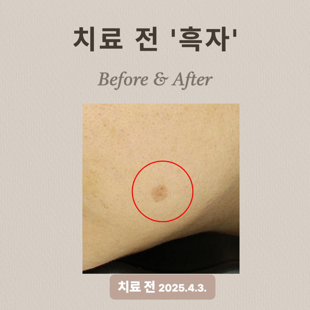 30대 흑자제거