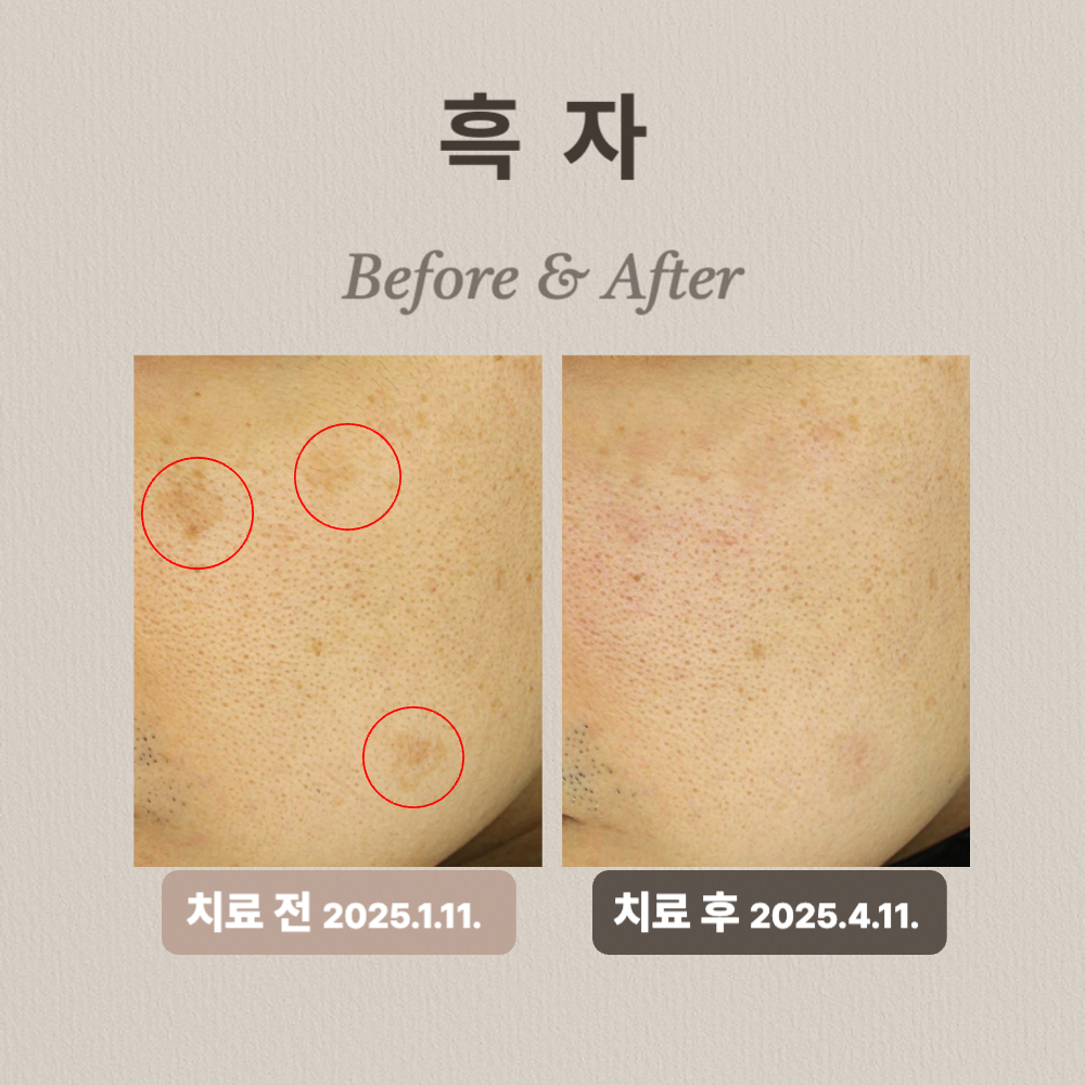 40대 흑자 제거 리팟레이저