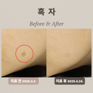30대 흑자 제거