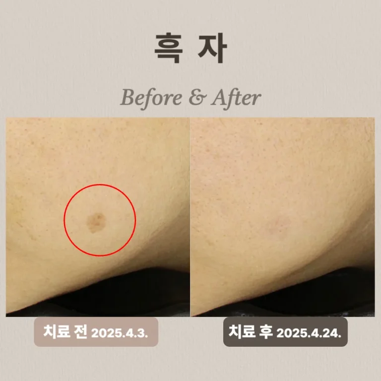 30대 흑자 치료 후기