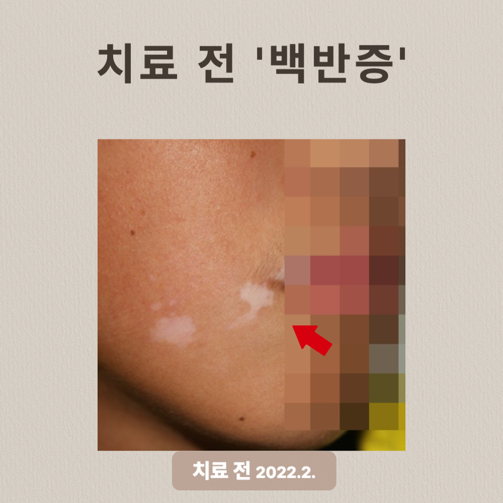10대 백반증 치료