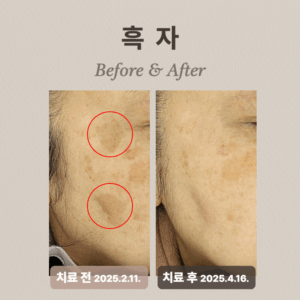 60대 기미, 흑자, 백반증