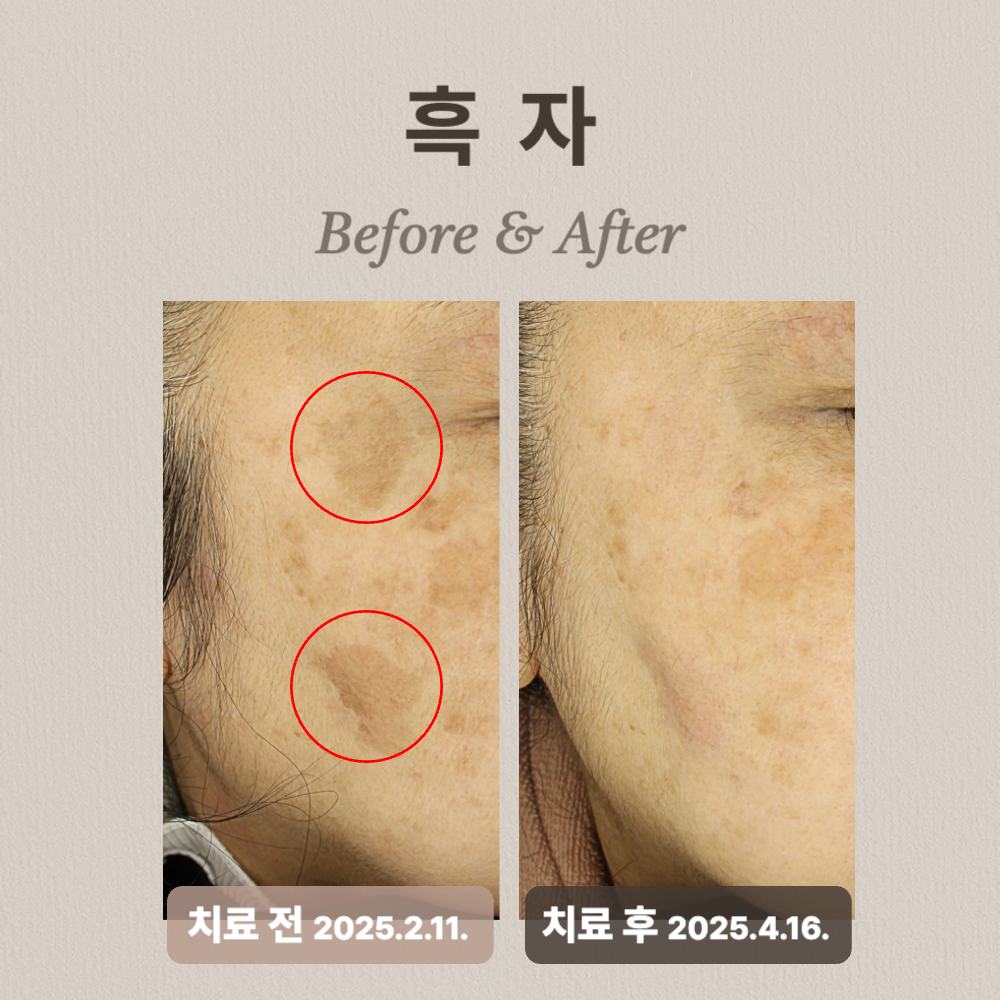 60대 기미, 흑자, 백반증
