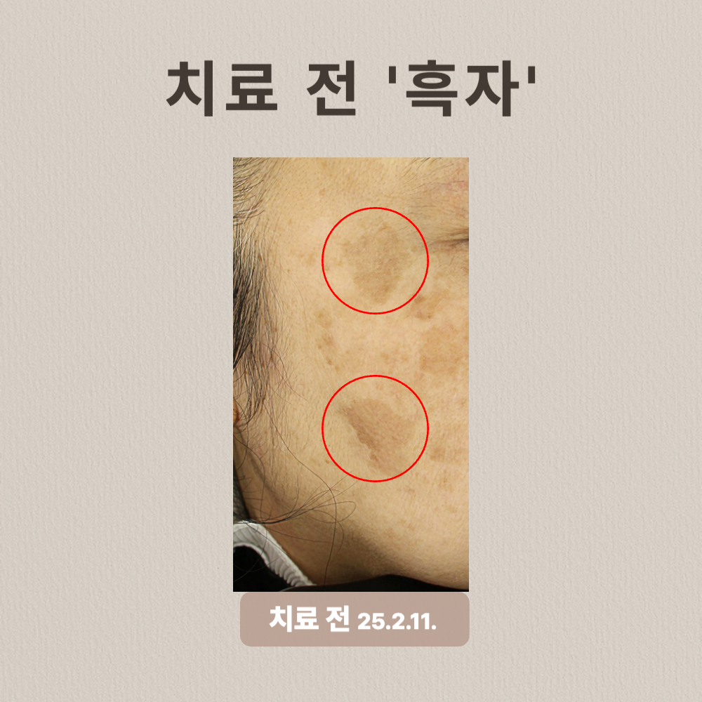 60대 기미, 흑자, 백반증