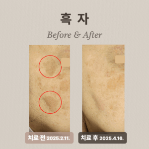 흑자