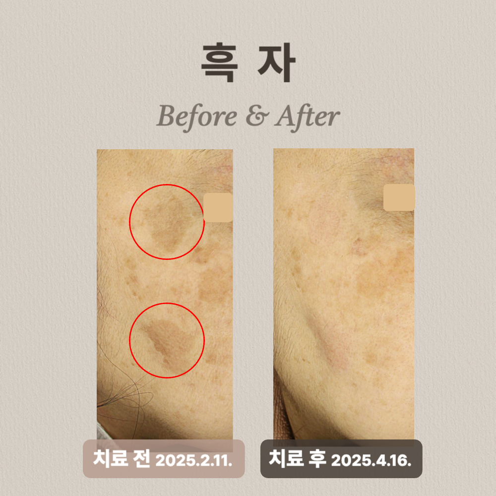 흑자