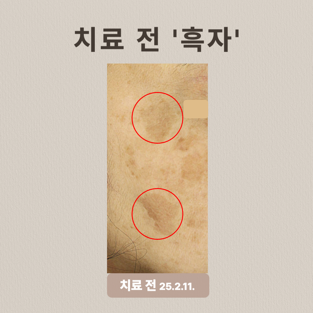 흑자 리팟레이저