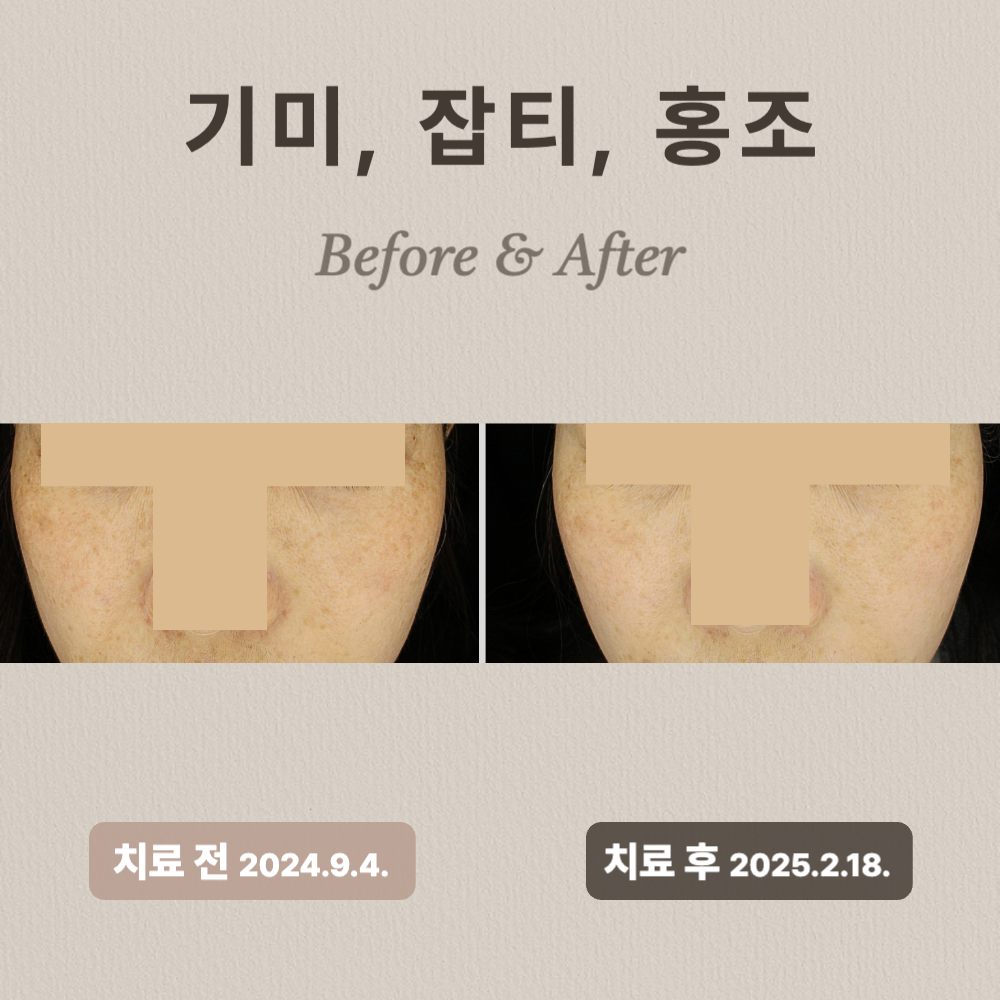 30대 기미, 잡티, 홍조 제거