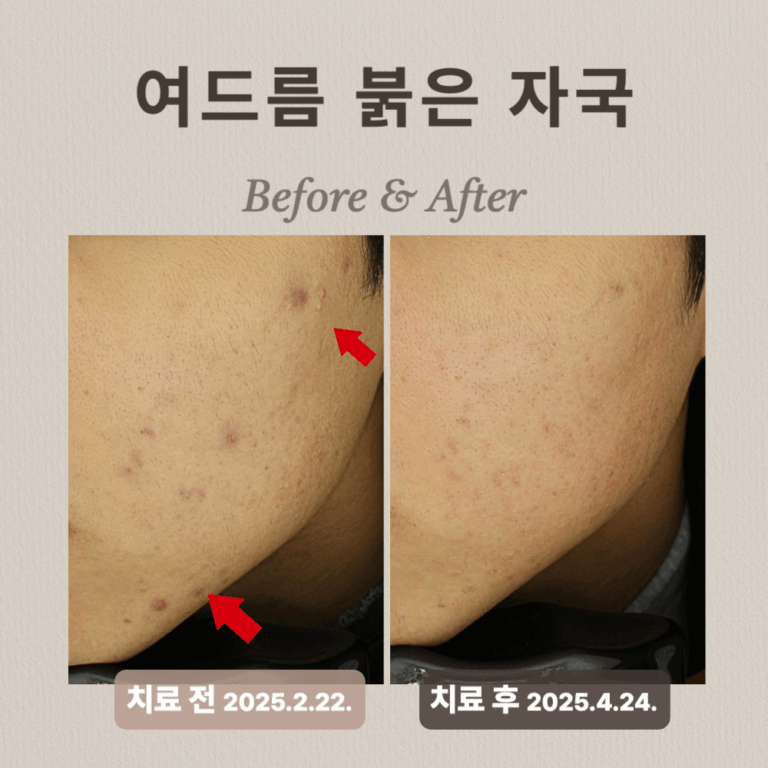 20대 남성, 여드름, 여드름홍반 치료 후기