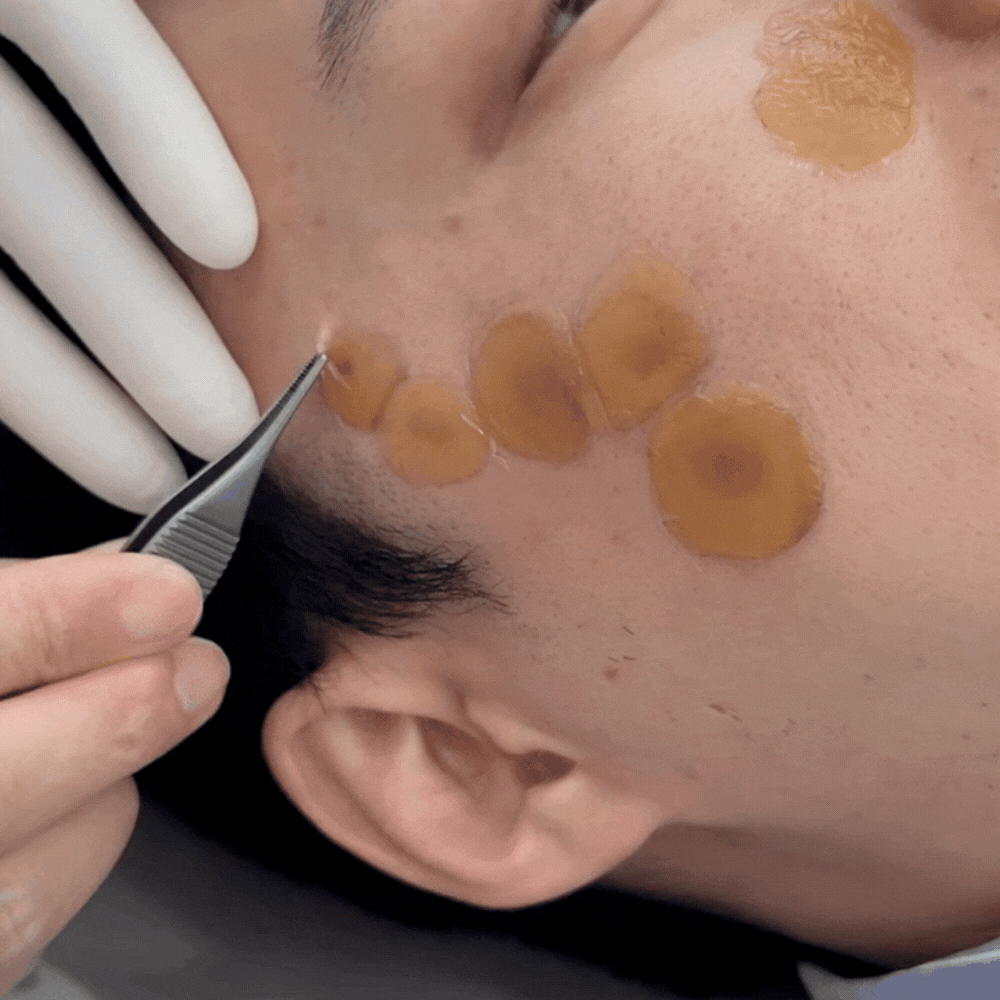 40대 흑자 제거 리팟레이저