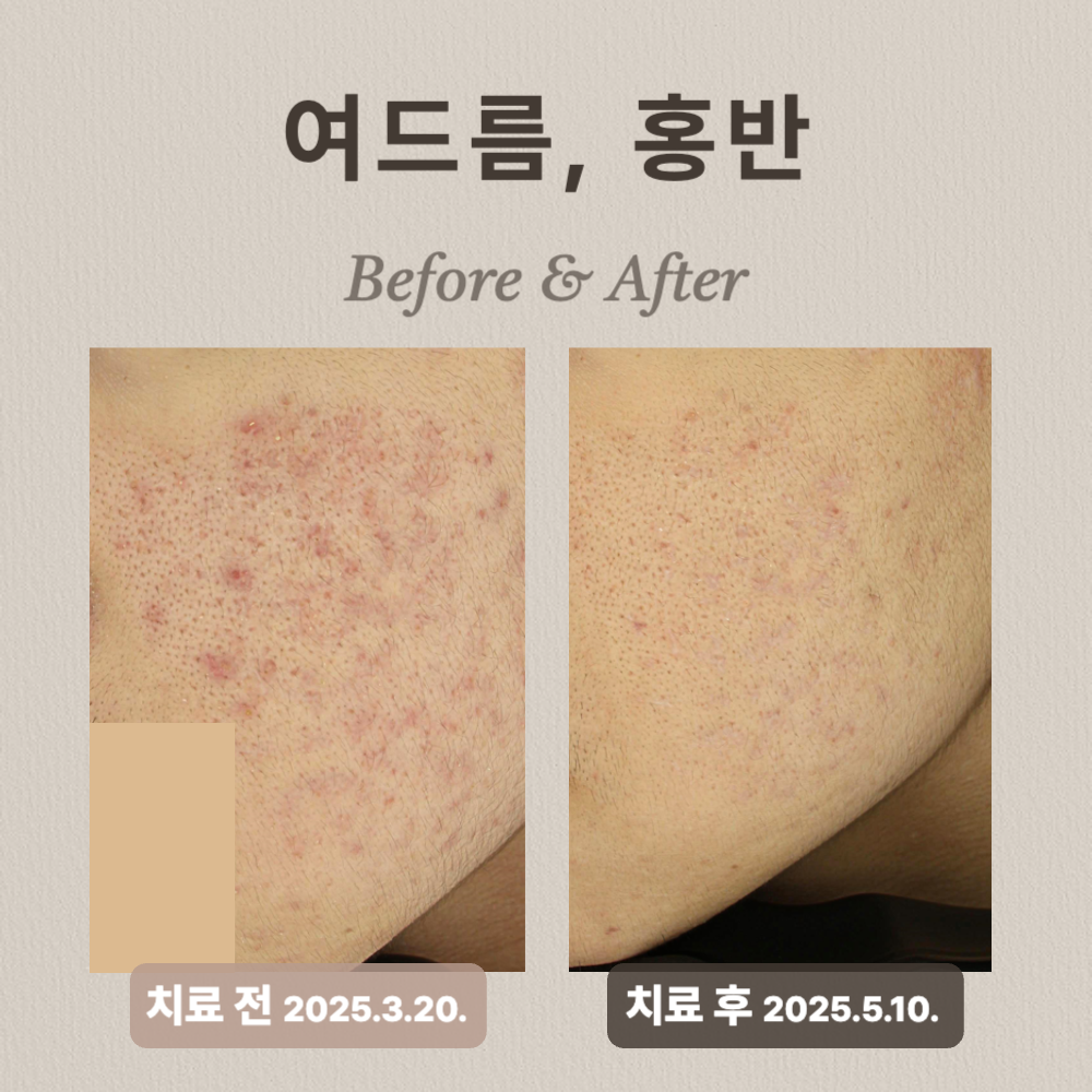 10대 여드름 홍반