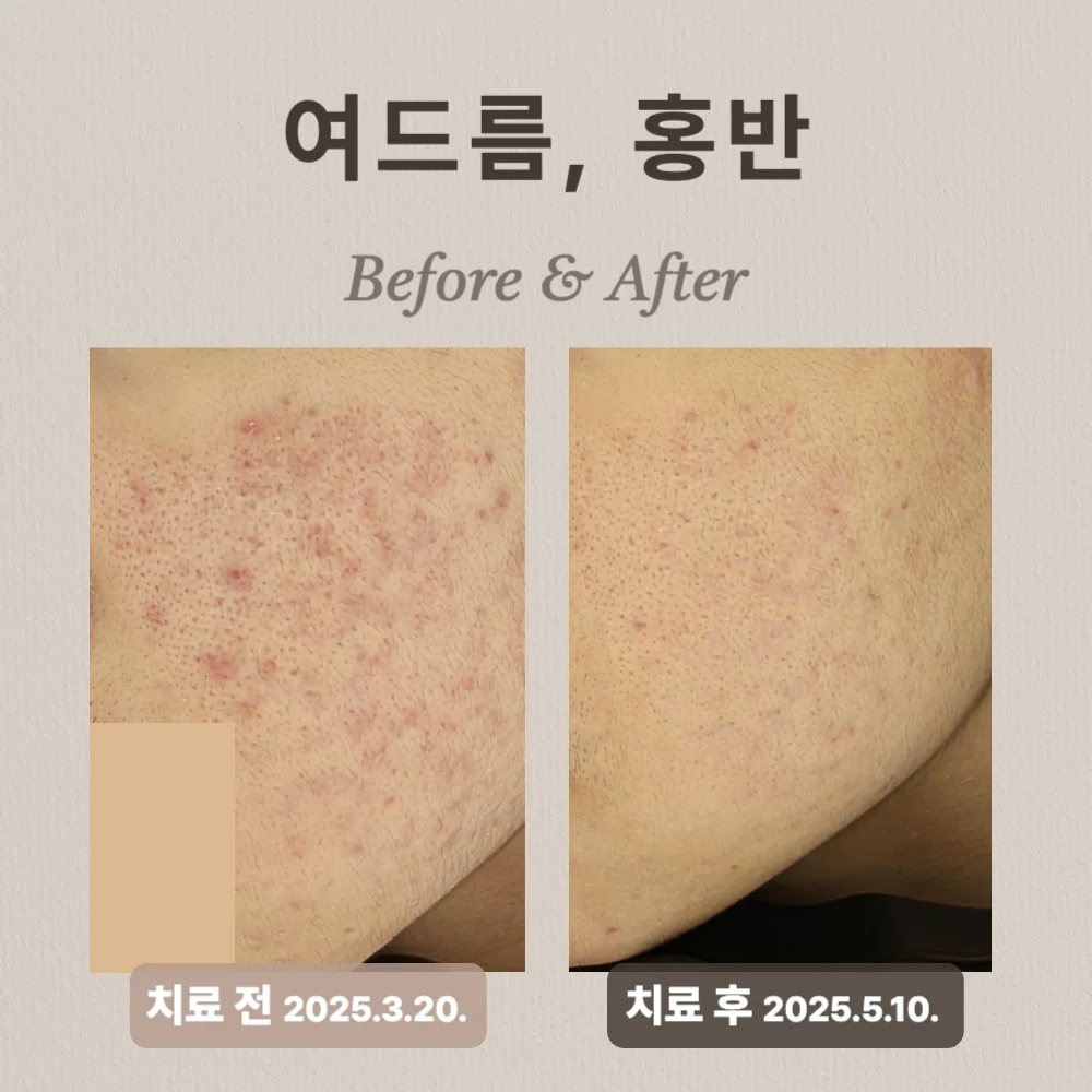 10대 남성, 여드름, 여드름홍반 치료 후기