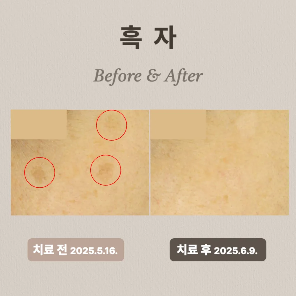 30대 여성 눈가 흑갈색 반점 흑자 치료 사례